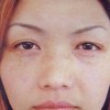 脸部黄褐斑如何治疗