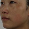 黄褐斑怎么治疗有效行为