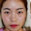 黄褐斑可以去掉吗