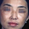 黄褐斑症状有什么  脸上有黄褐斑要怎么治疗