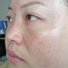 简介黄褐斑的发病症状