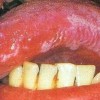 艾滋病初期常见的症状_艾滋病