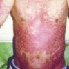 艾滋病感染早期的症状_艾滋病