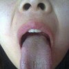 艾滋病有什么症状