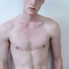 艾滋病感染症状_艾滋病