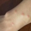 艾滋病常见的一些临床症状