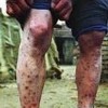 艾滋病毒感染症状_艾滋病