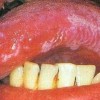 艾滋病的潜伏期特点介绍_艾滋病