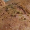 正确预防痤疮的办法有什么