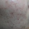 痤疮有哪些发病特点