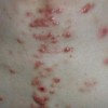 痤疮要怎样预防比较好