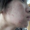 痤疮的病因都有什么呢