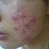 痤疮有哪些表现症状呢
