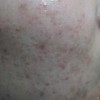 7个妙招如何让痤疮远离你