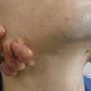 痤疮能彻底缓解吗 (2)