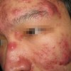人得了痤疮久治不愈该怎么办
