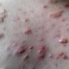 22岁女孩分享痤疮康复经验