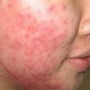 痤疮病者如何进行有效措施