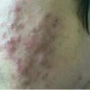 痤疮非青春期专利 延迟治疗危害大