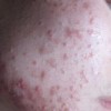 5种可用于治疗痤疮的中成药