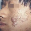 皮肤科专家：痤疮需科学治疗