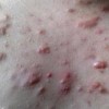 医院痤疮疤痕最好的治疗手段是什么
