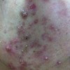 治疗痤疮到那个医院好
