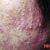治疗痤疮 找准疗法是关键