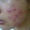 青岛看痤疮医院哪家好