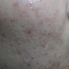 痤疮怎么治疗