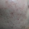 面部痤疮怎么治疗 (5)