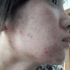 痤疮的治疗费用