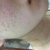 脸上粉刺分布部位的不同