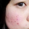 痤疮粉刺暗疮三者的区别和防护