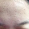 大学生满脸粉刺 中西合一很凑效
