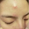 怎么去黑头粉刺