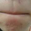 粉刺的存在