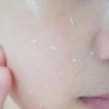 青春痘和粉刺是一回事吗