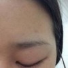 如何判断粉刺性痤疮