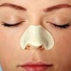 如何治疗和治疗我们脸上的粉刺