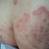 股癣的多发季节怎样预防
