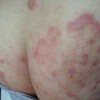 股癣轻微什么症状
