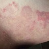 股癣的症状是什么呢
