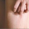 怎么治疗过敏性鼻炎
