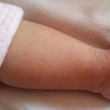 金属过敏怎么办