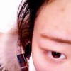 过敏要如何治