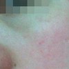 患者需要如何做好肌肤的护理