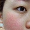 红血丝的形成因素