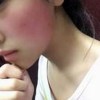 高温天气红血丝红血丝形成因素有几下几点