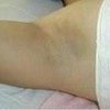 狐臭的患者在平常生活中应当有哪些要注意呢